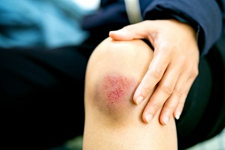 La caléndula, tu aliado en las heridas: calendula heridas heelespaña - HeelEspaña