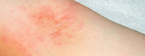 Dermatitis Atópica y Psoriasis - Principales Diferencias: Dermatitis Atópica imagen 1 - HeelEspaña