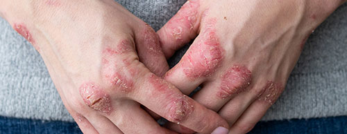 Dermatitis Atópica y Psoriasis - Principales Diferencias: Psoriasis imagen manos 1 - HeelEspaña