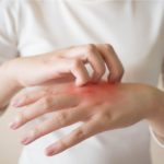 ¿Cómo calmar la piel irritada? | Alivia los síntomas: sequedad manos heelespana 1 150x150 - HeelEspaña