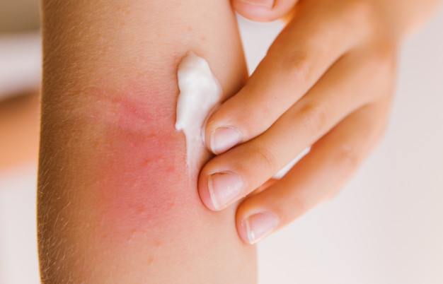 Piel seca con el frío | ¡Evita que las bajas temperaturas maltraten tu piel!: aplicar crema sobre dermatitis atopica - HeelEspaña