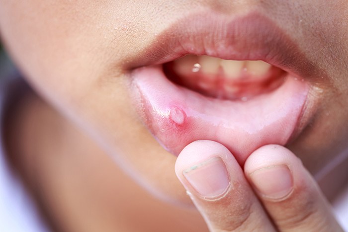 Causas: por qué aparecen las llagas en la boca