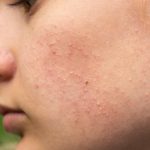¿Cuánto sufre la piel tras la depilación? Consejos y cuidados: dermatitis piel uso mascarilla 150x150 - HeelEspaña