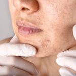 ¿Cuáles son los problemas de la piel con el uso de mascarilla?