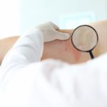 Dermatitis en las manos por frío: síntomas y tratamiento: dermatitis atopica verano 1 150x150 - HeelEspaña