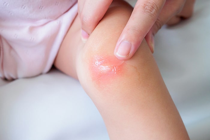 Dermatitis atópica en verano | Consejos para cuidar tu piel: trucos dermatitis atopica verano - HeelEspaña