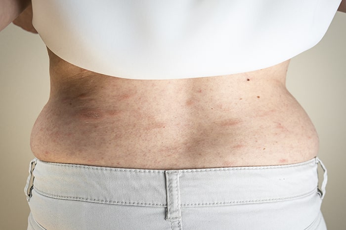 5 señales en tu piel que indican problemas de salud: manchas piel - HeelEspaña