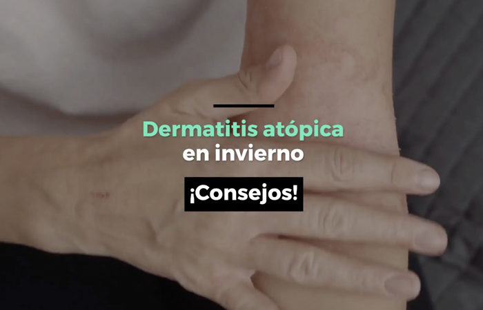 Dermatitis atópica en invierno | Consejos: dermatitis atopica invierno consejos 700x450 - HeelEspaña