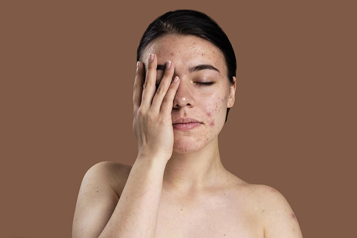 ¿Influye la alimentación en mi piel?: problemas de piel - HeelEspaña