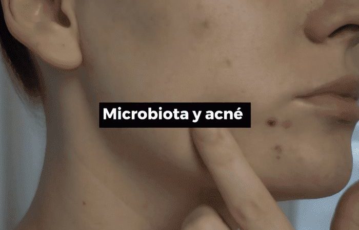 Relación de la microbiota con la aparición del acné