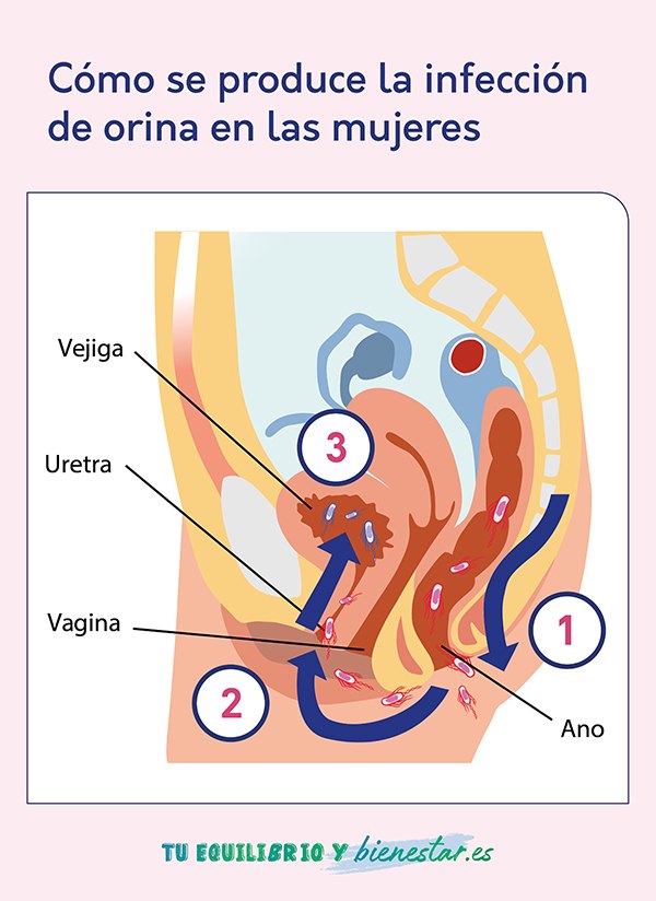 Infecciones urinarias en mujeres, ¿por qué son más propensas?: infeccion orina mujeres - HeelEspaña