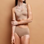 Cuidados de la piel después de tomar el sol en vacaciones: manchas piel 150x150 - HeelEspaña