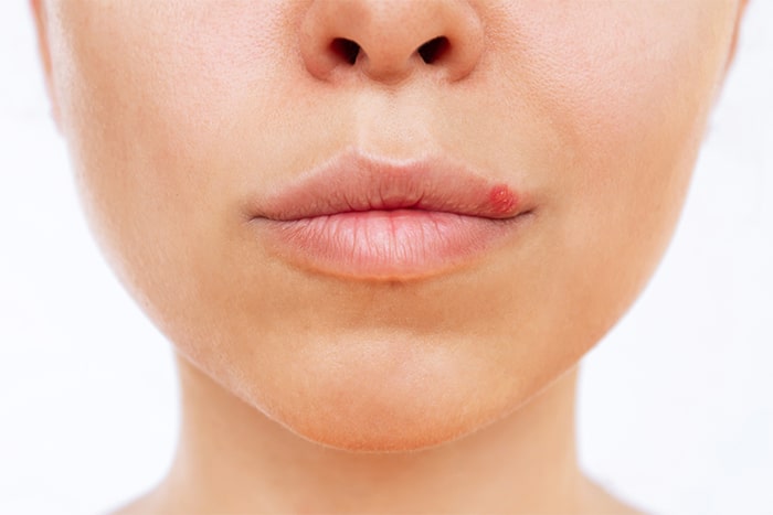 ¿Los besos transmiten bacterias?: herpes labio - HeelEspaña