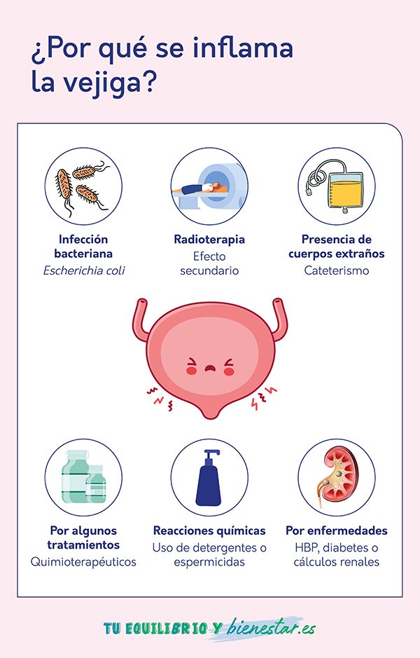 ¿Cuáles son los síntomas de la vejiga inflamada?: se inflama la vejiga - HeelEspaña