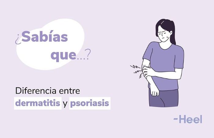 En qué se diferencian la psoriasis y la dermatitis