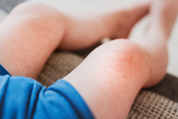 Aparición de eczema en la piel por el clima invernal: dermatitis - HeelEspaña