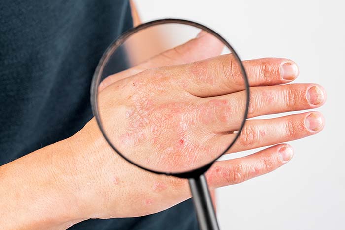 Aparición de eczema en la piel por el clima invernal: piel sensible - HeelEspaña