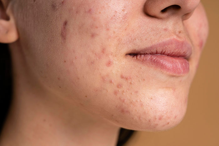 Cómo identificar mi tipo de piel: piel acne - HeelEspaña