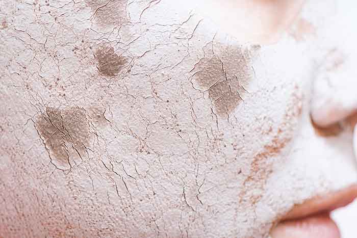 Piel escamada y picor: causas sorprendentes y soluciones efectivas: piel seca - HeelEspaña