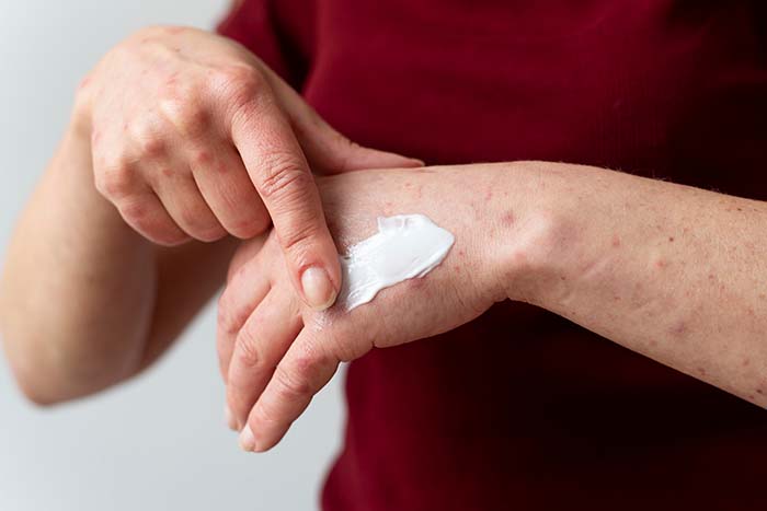 Dermatitis nerviosa: qué es y cómo tratarla: cremas dermatitis - HeelEspaña